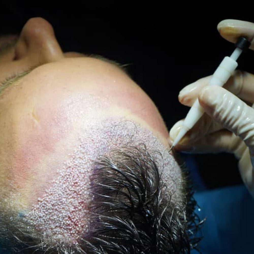 DHI hair transplant for men