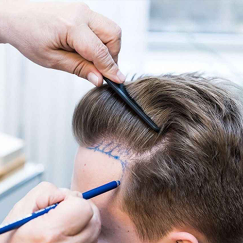 DHI hair transplant for receding hairline