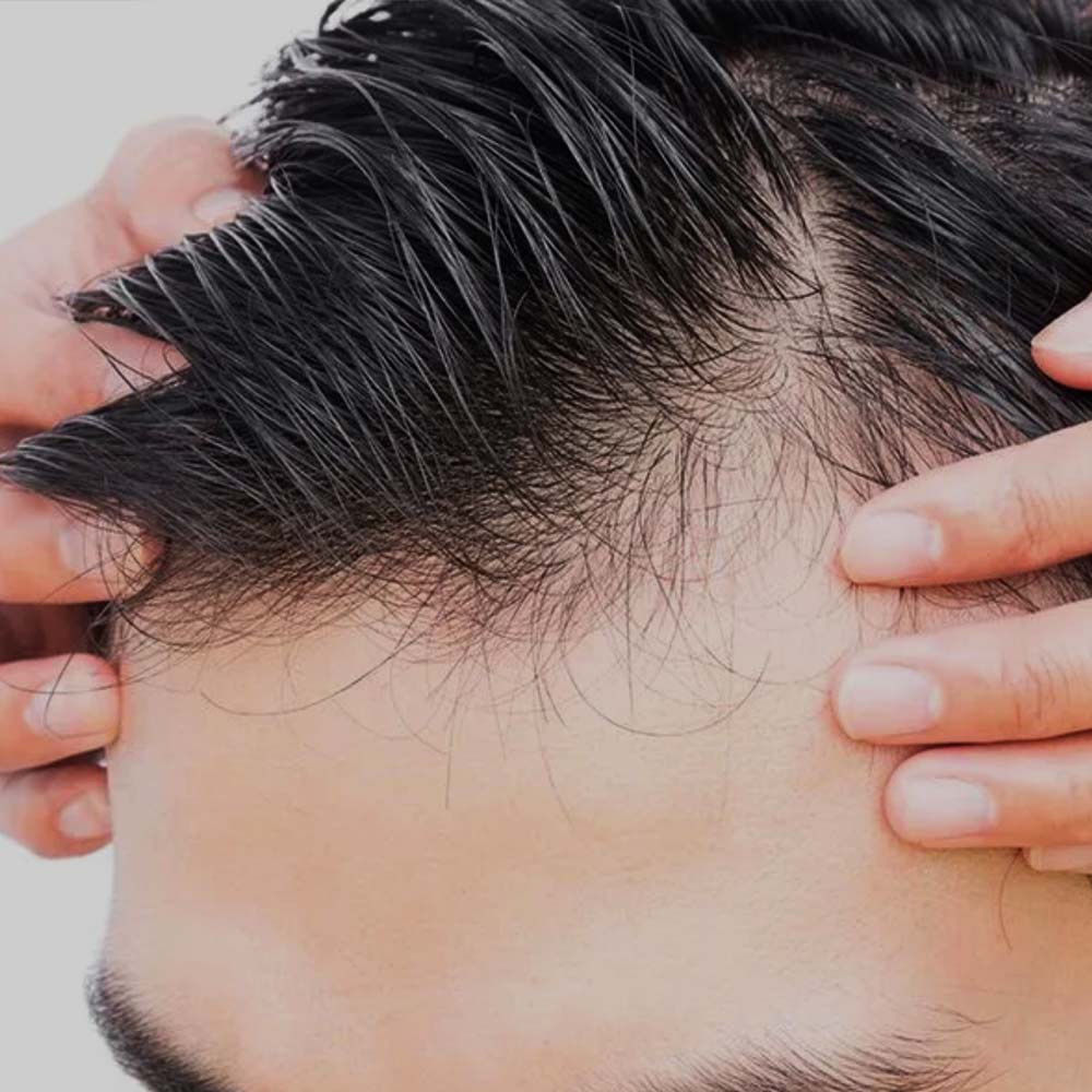 DHI hair transplant for thinning hair