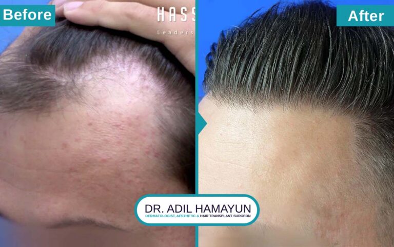 Best FUT Hair Transplant in Peshawar & Islamabad