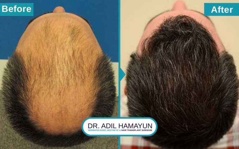 Best FUT Hair Transplant in Peshawar & Islamabad