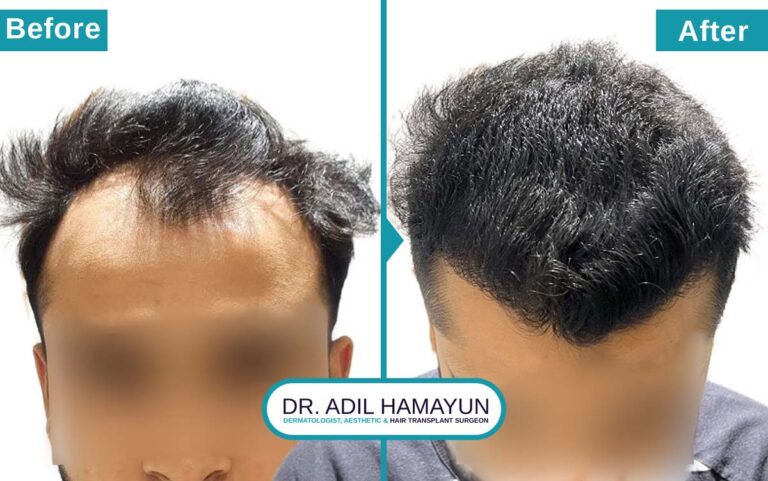 Best FUT Hair Transplant in Peshawar & Islamabad