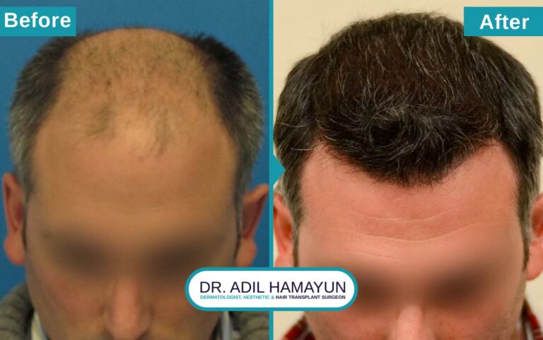 Best FUT Hair Transplant in Peshawar & Islamabad