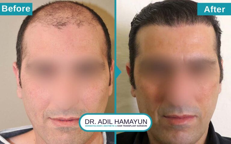 Best FUT Hair Transplant in Peshawar & Islamabad