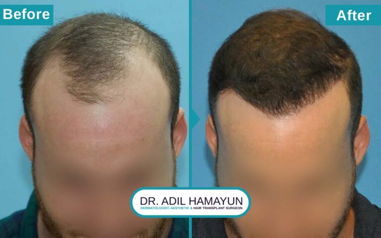 Best FUT Hair Transplant in Peshawar & Islamabad