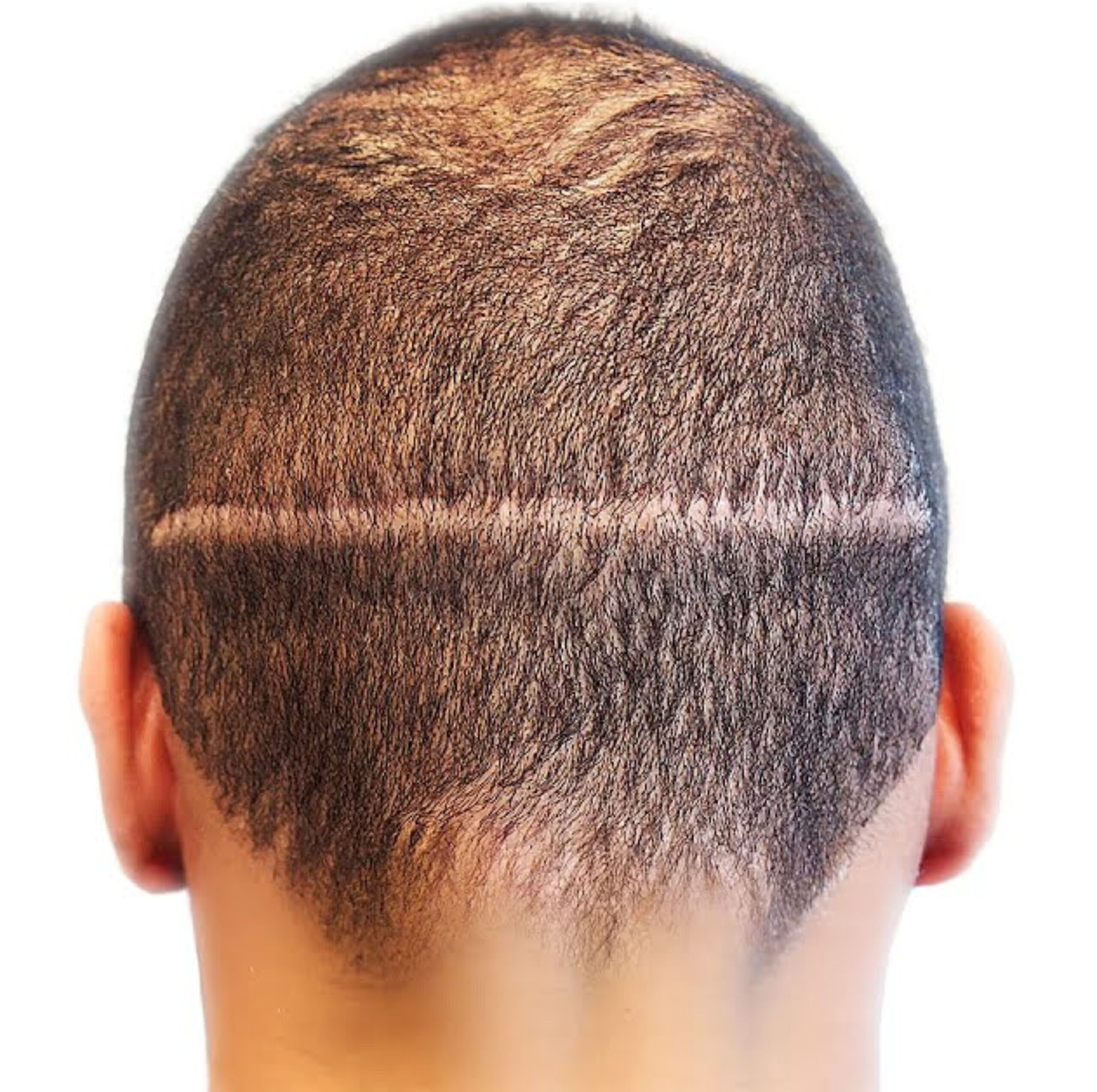 Best FUT Hair Transplant In Peshawar And Islamabad for men