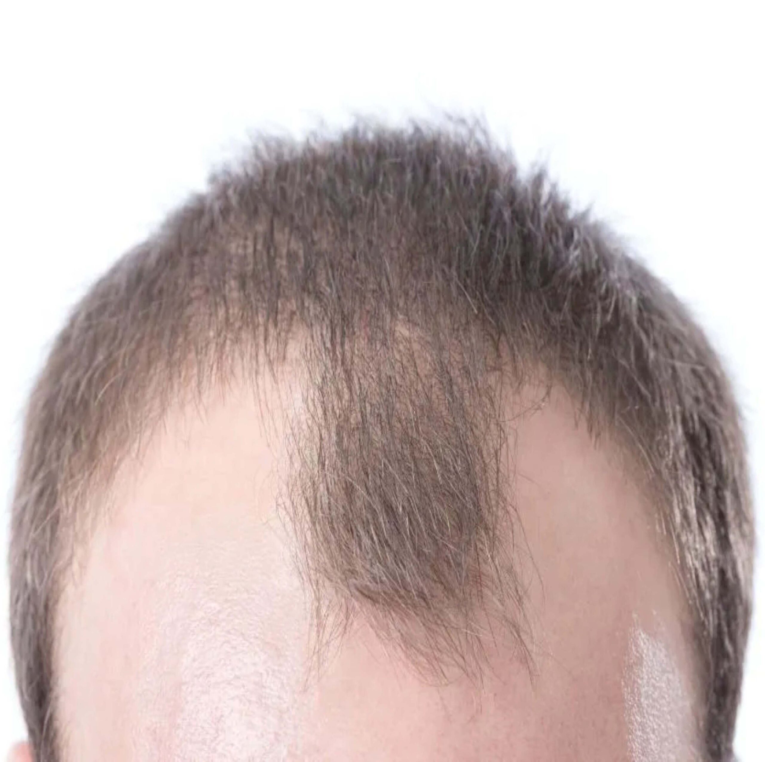 FUT Hair Transplant for Receding Hairline