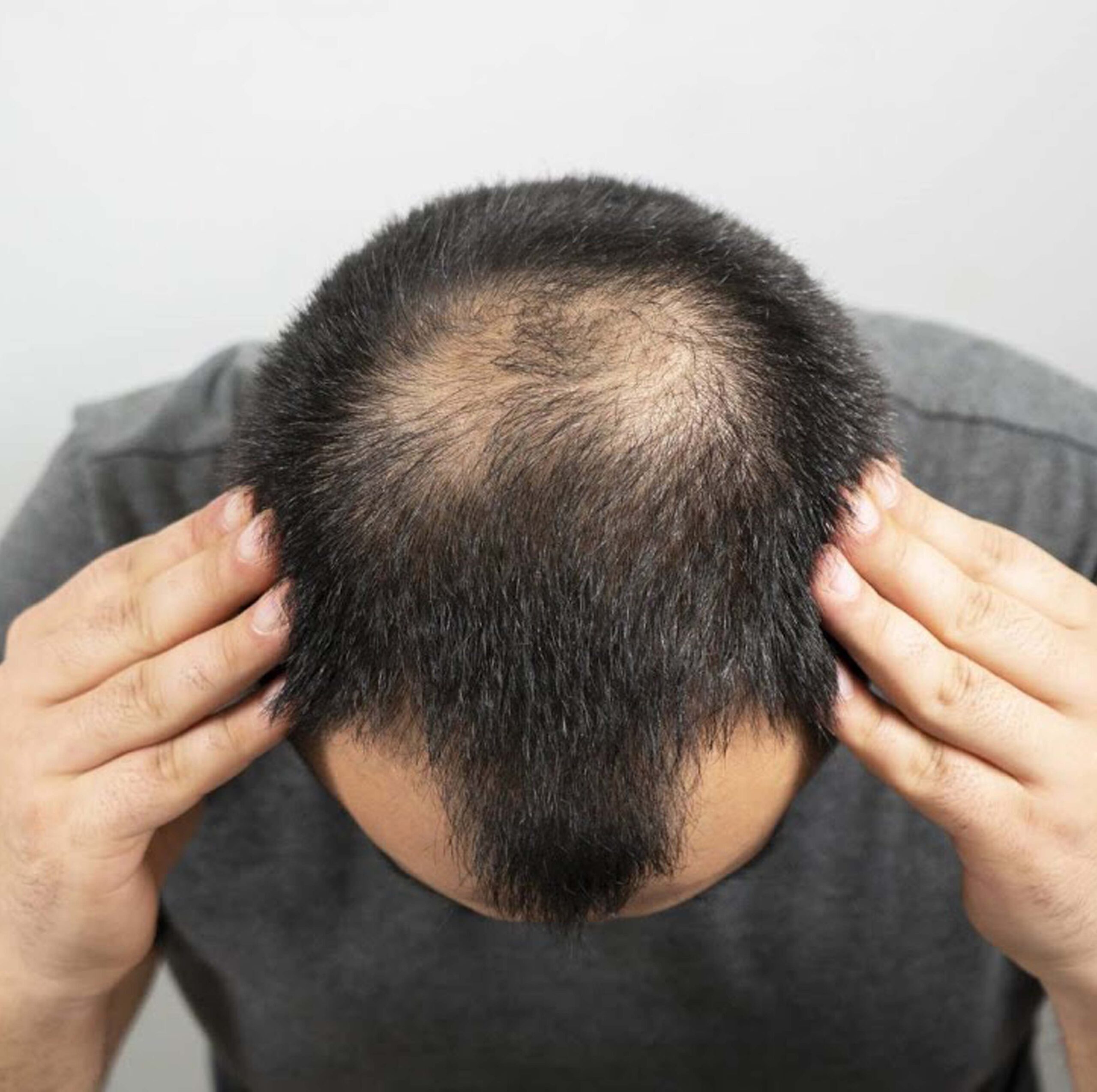 FUT Hair Transplant for Thinning Hair