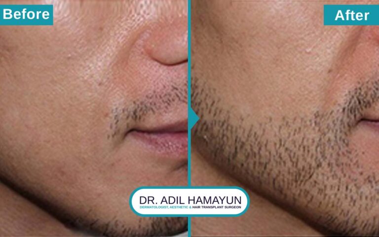 Best Beard Hair Transplant in Peshawar & Islamabad