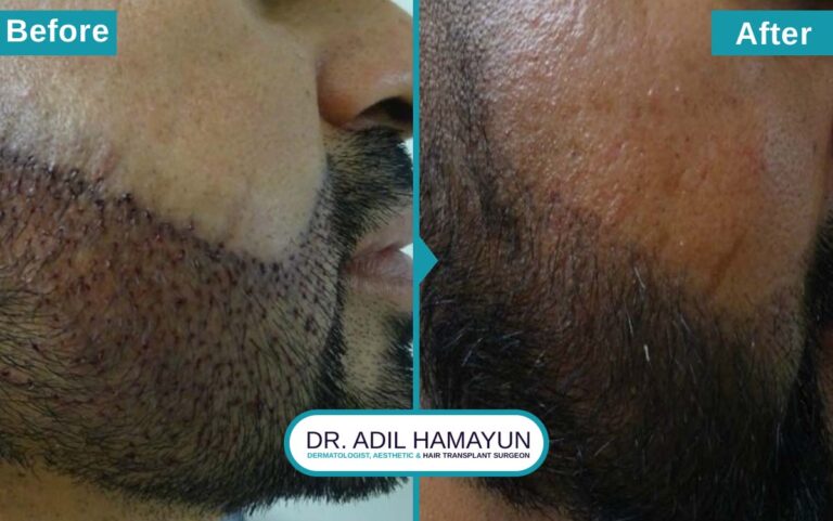 Best Beard Hair Transplant in Peshawar & Islamabad