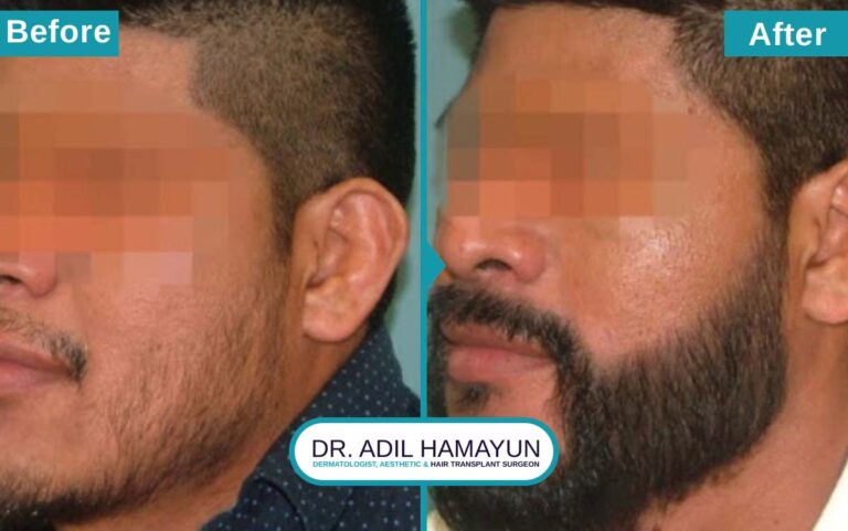 Best Beard Hair Transplant in Peshawar & Islamabad