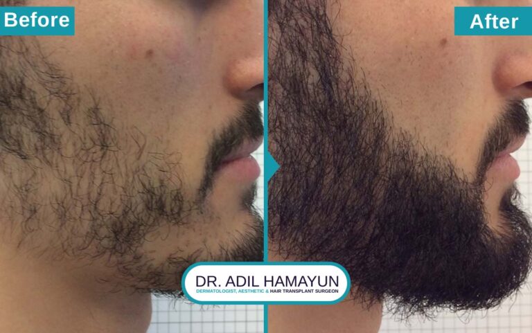 Best Beard Hair Transplant in Peshawar & Islamabad