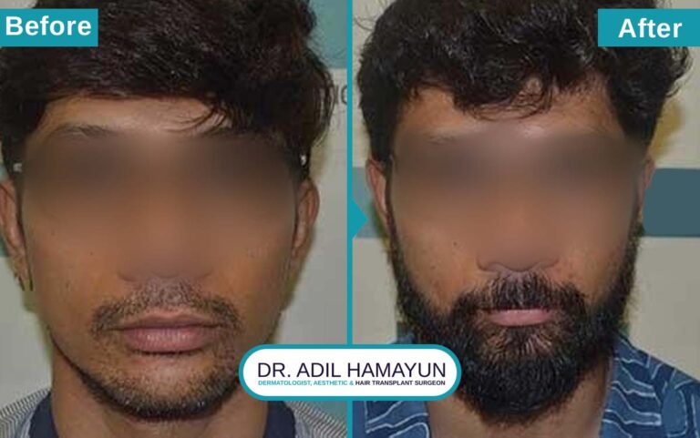 Best Beard Hair Transplant in Peshawar & Islamabad