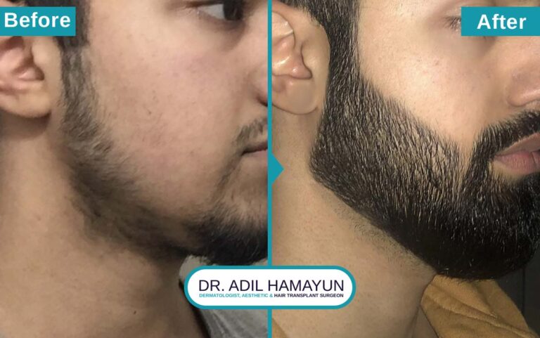 Best Beard Hair Transplant in Peshawar & Islamabad