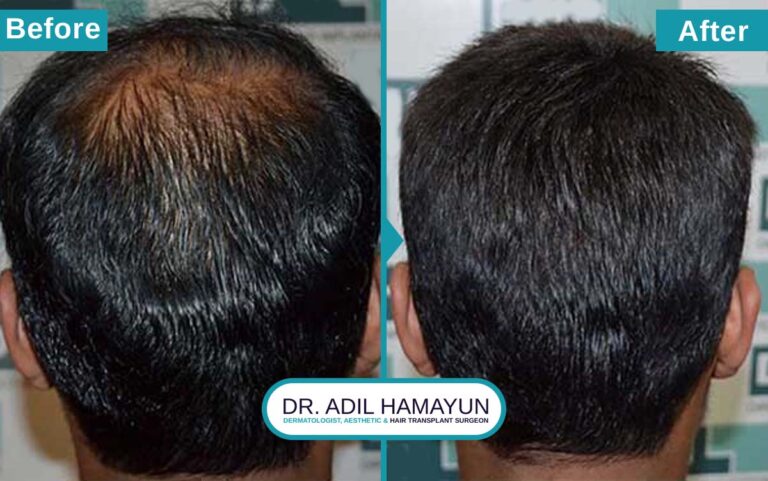 Best DHI Hair Transplant in Peshawar & Islamabad