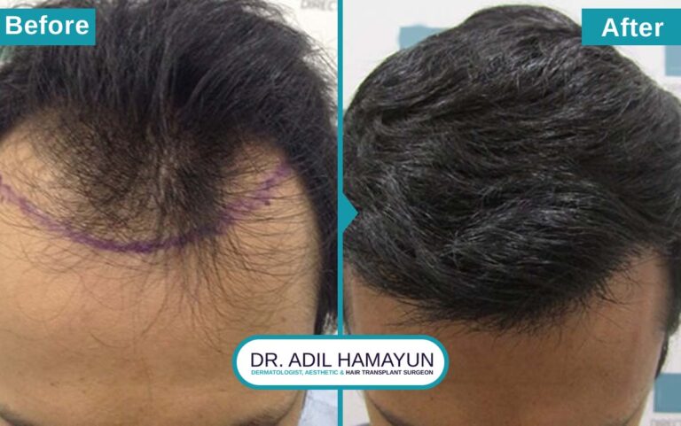 Best DHI Hair Transplant in Peshawar & Islamabad