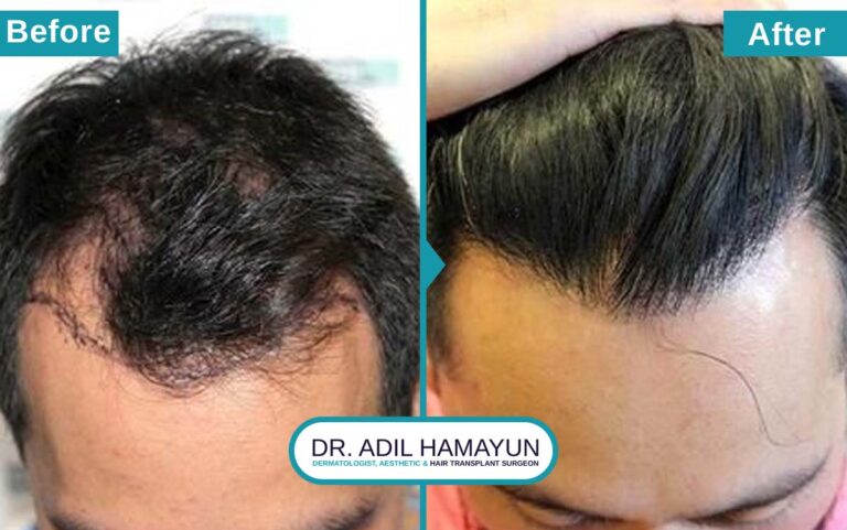 Best DHI Hair Transplant in Peshawar & Islamabad