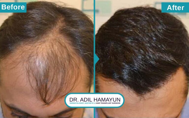 Best DHI Hair Transplant in Peshawar & Islamabad