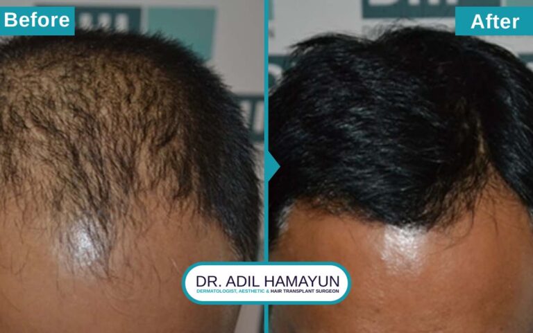 Best DHI Hair Transplant in Peshawar & Islamabad