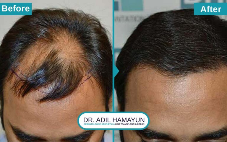 Best DHI Hair Transplant in Peshawar & Islamabad