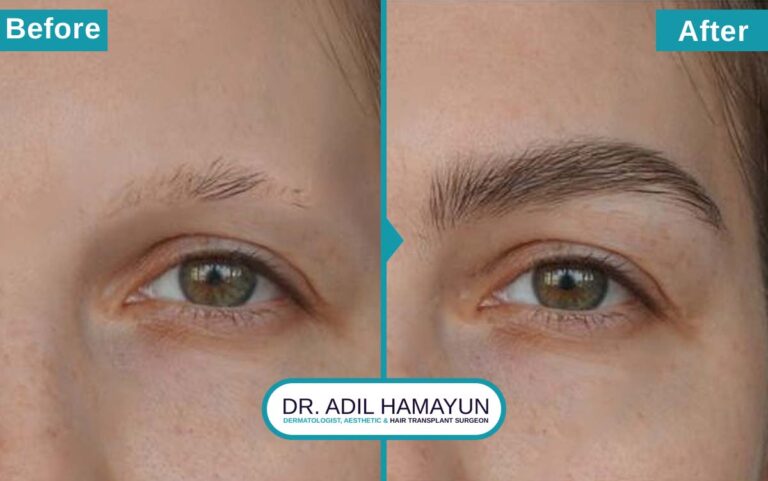 FUE Eye Brow Hair Transplant in Peshawar & Islamabad