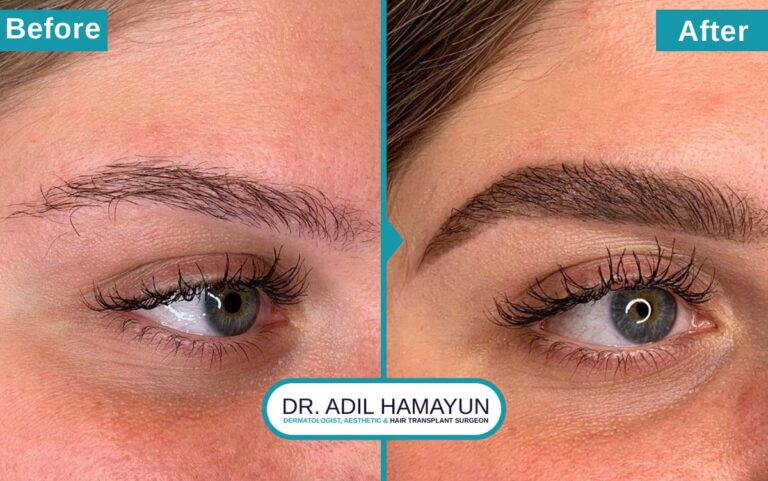 FUE Eye Brow Hair Transplant in Peshawar & Islamabad