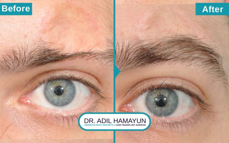 FUE Eye Brow Hair Transplant in Peshawar & Islamabad