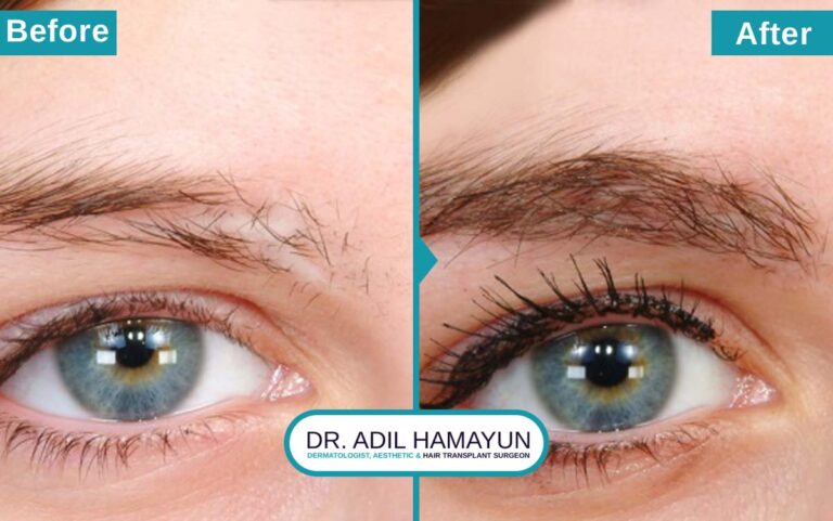 FUE Eye Brow Hair Transplant in Peshawar & Islamabad