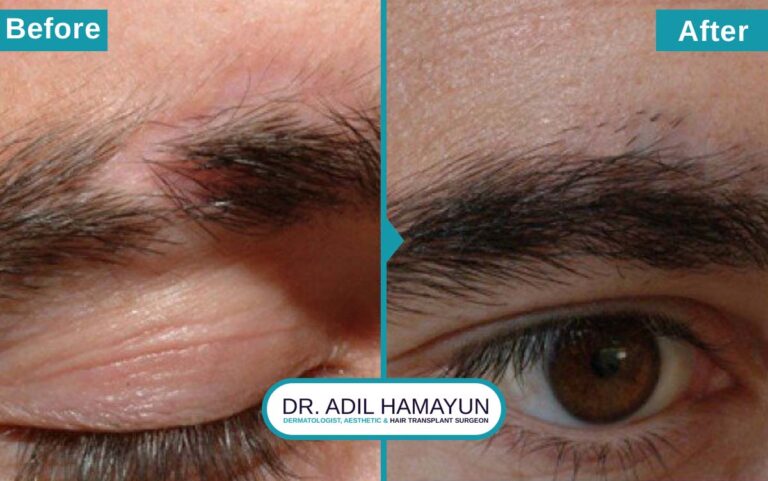 FUE Eye Brow Hair Transplant in Peshawar & Islamabad