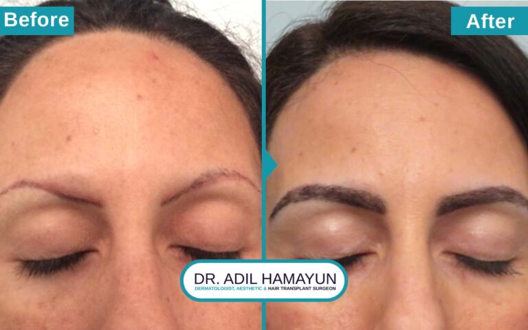 FUE Eye Brow Hair Transplant in Peshawar & Islamabad