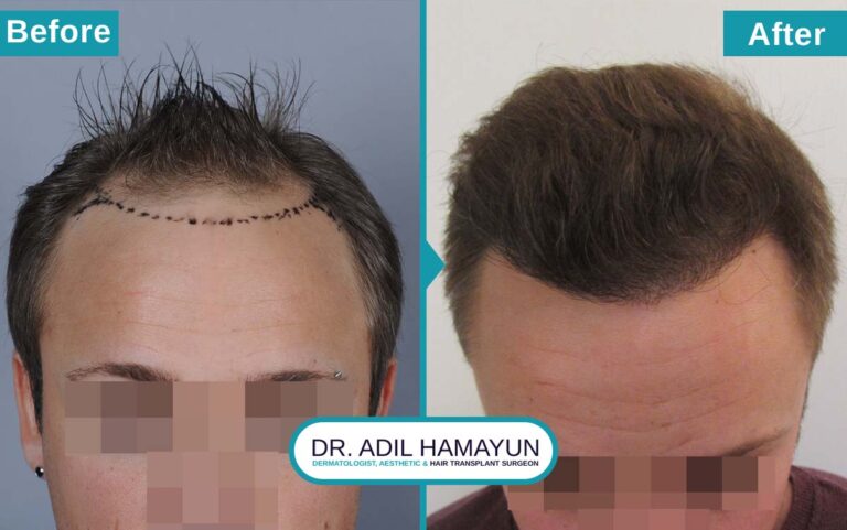 Best Unshaved Hair Transplant in Peshawar & Islamabad