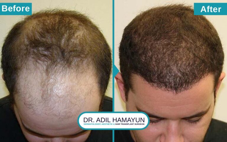 Best Unshaved Hair Transplant in Peshawar & Islamabad