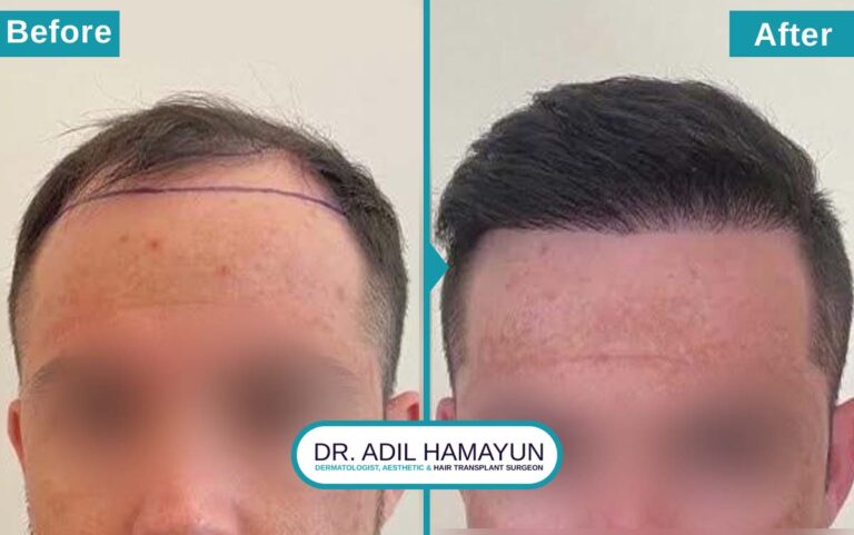 Best Unshaved Hair Transplant in Peshawar & Islamabad