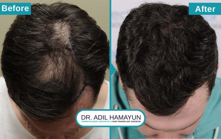 Best Unshaved Hair Transplant in Peshawar & Islamabad