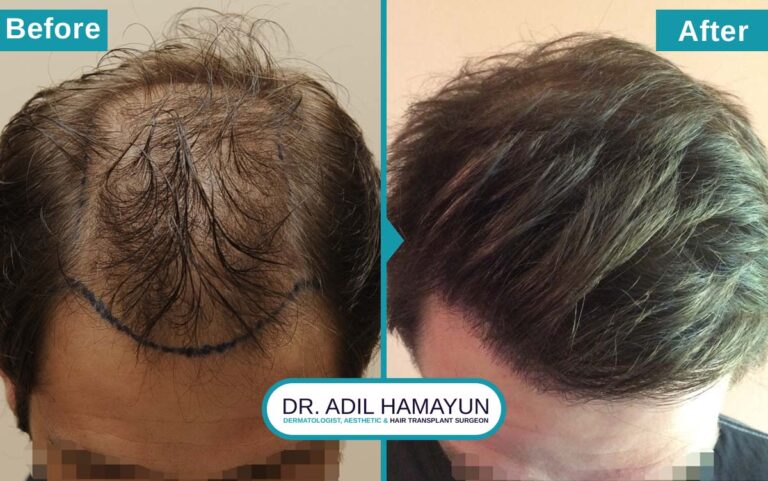 Best Unshaved Hair Transplant in Peshawar & Islamabad