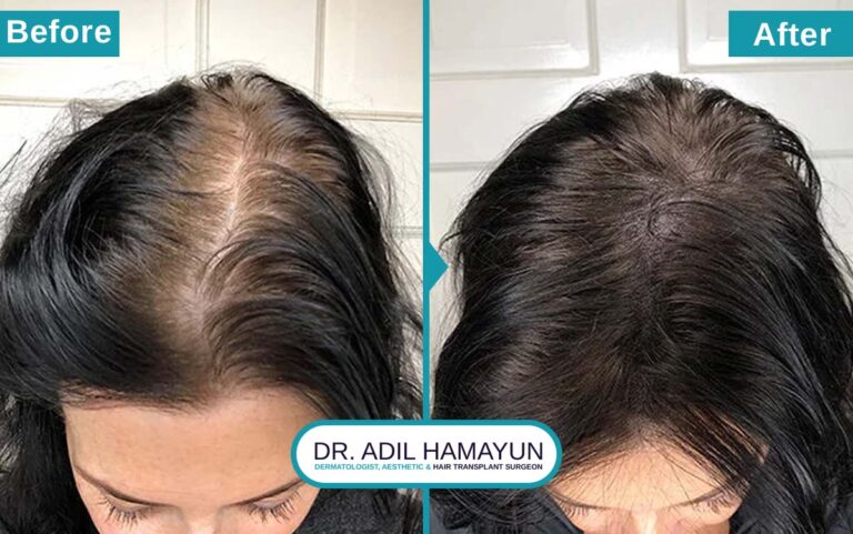 Best Hair Transplant For Women in Peshawar & Islamabad