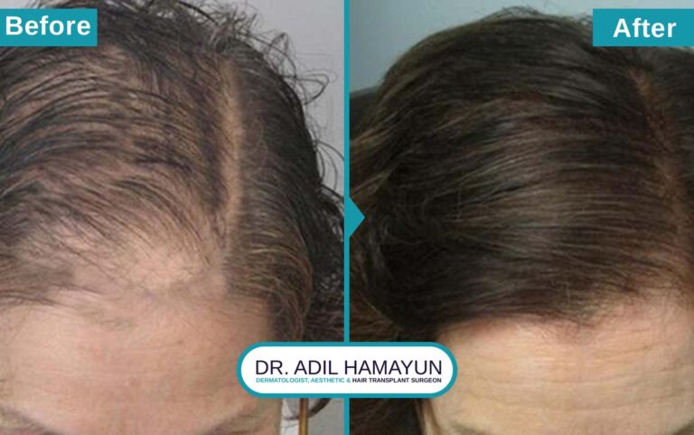 Best Hair Transplant For Women in Peshawar & Islamabad