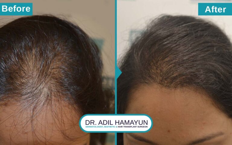 Best Hair Transplant For Women in Peshawar & Islamabad