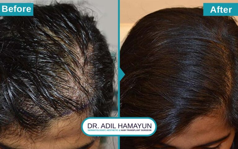 Best Hair Transplant For Women in Peshawar & Islamabad