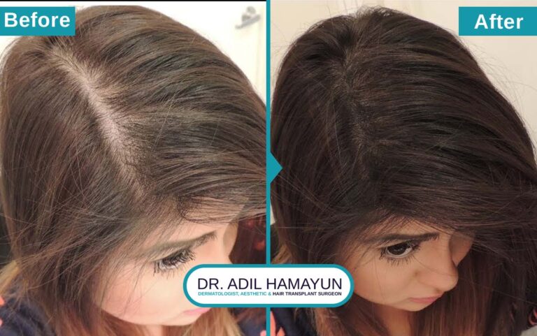 Best Hair Transplant For Women in Peshawar & Islamabad