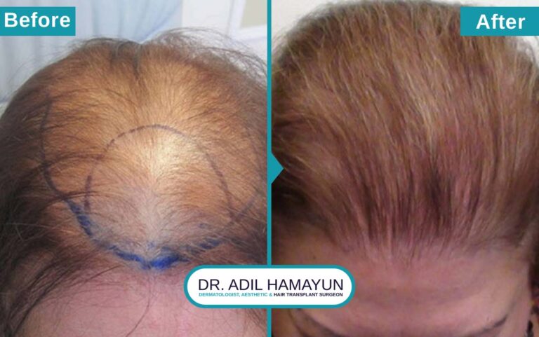 Best Hair Transplant For Women in Peshawar & Islamabad