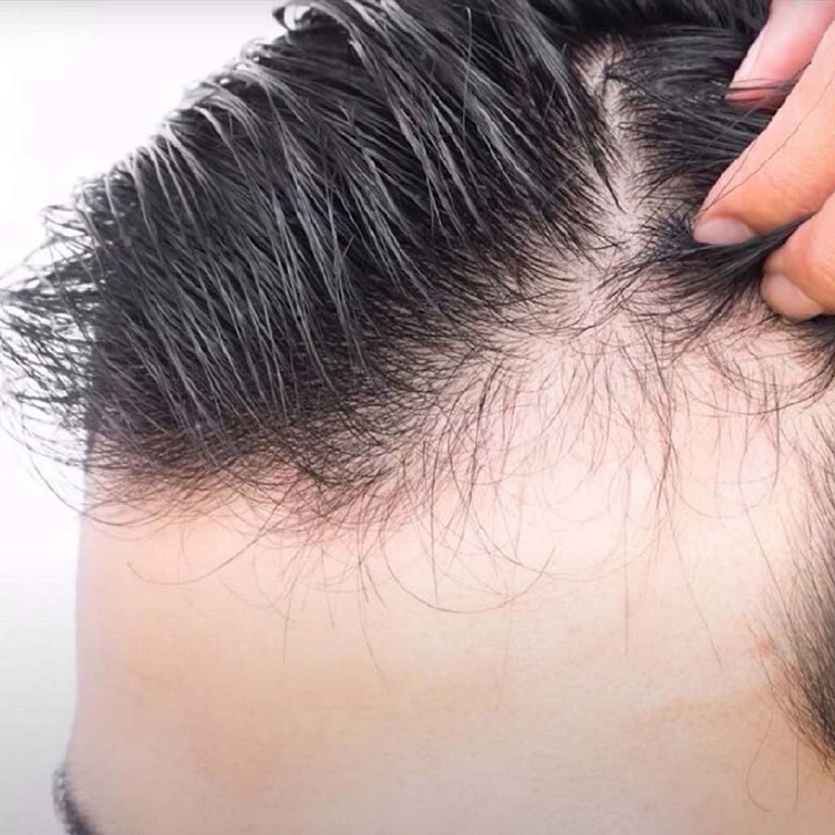 Hair Growth Tips, Hair Transplant ke Nuksan and Hair Transplant Maximum Grafts