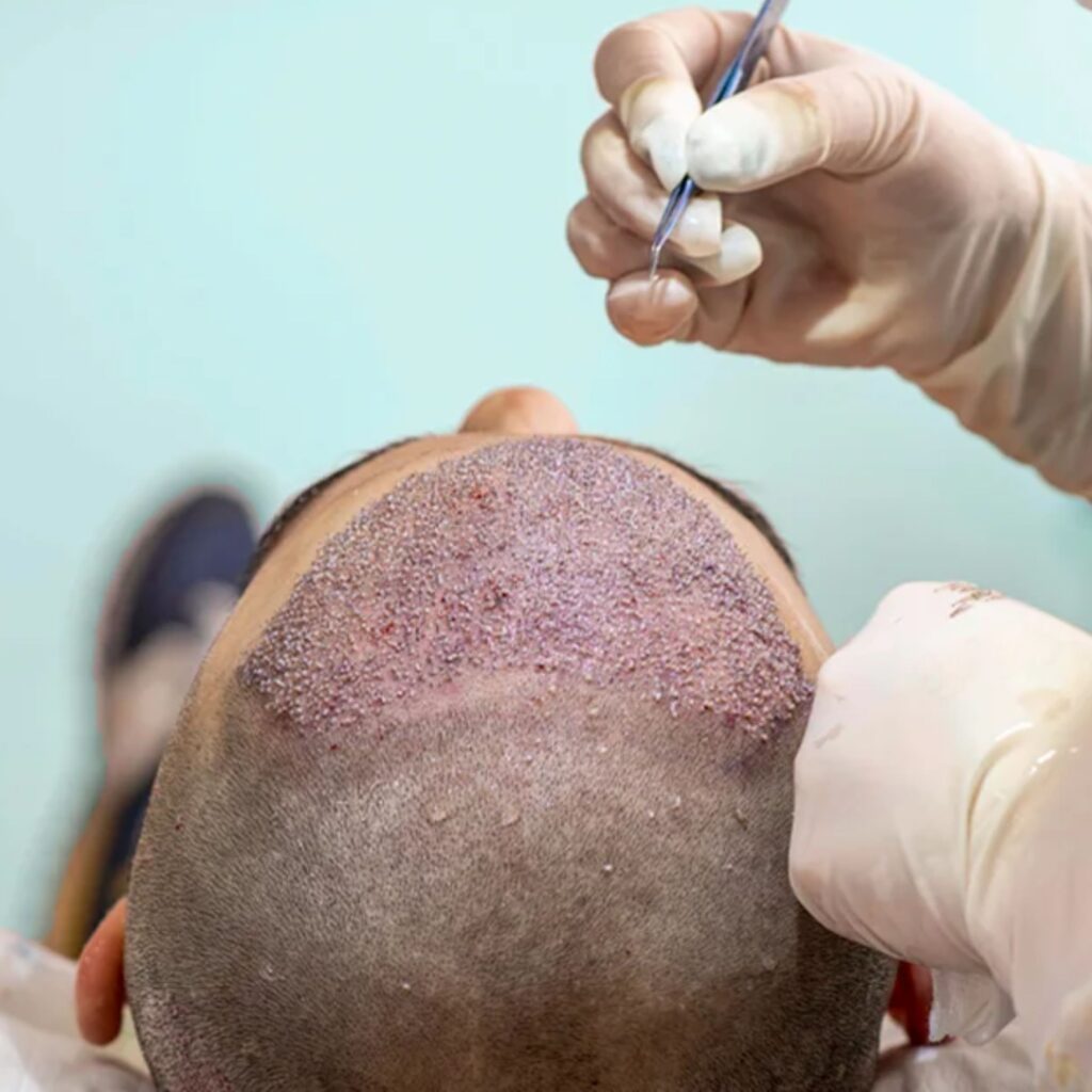 New Hair Transplant Technology 2025