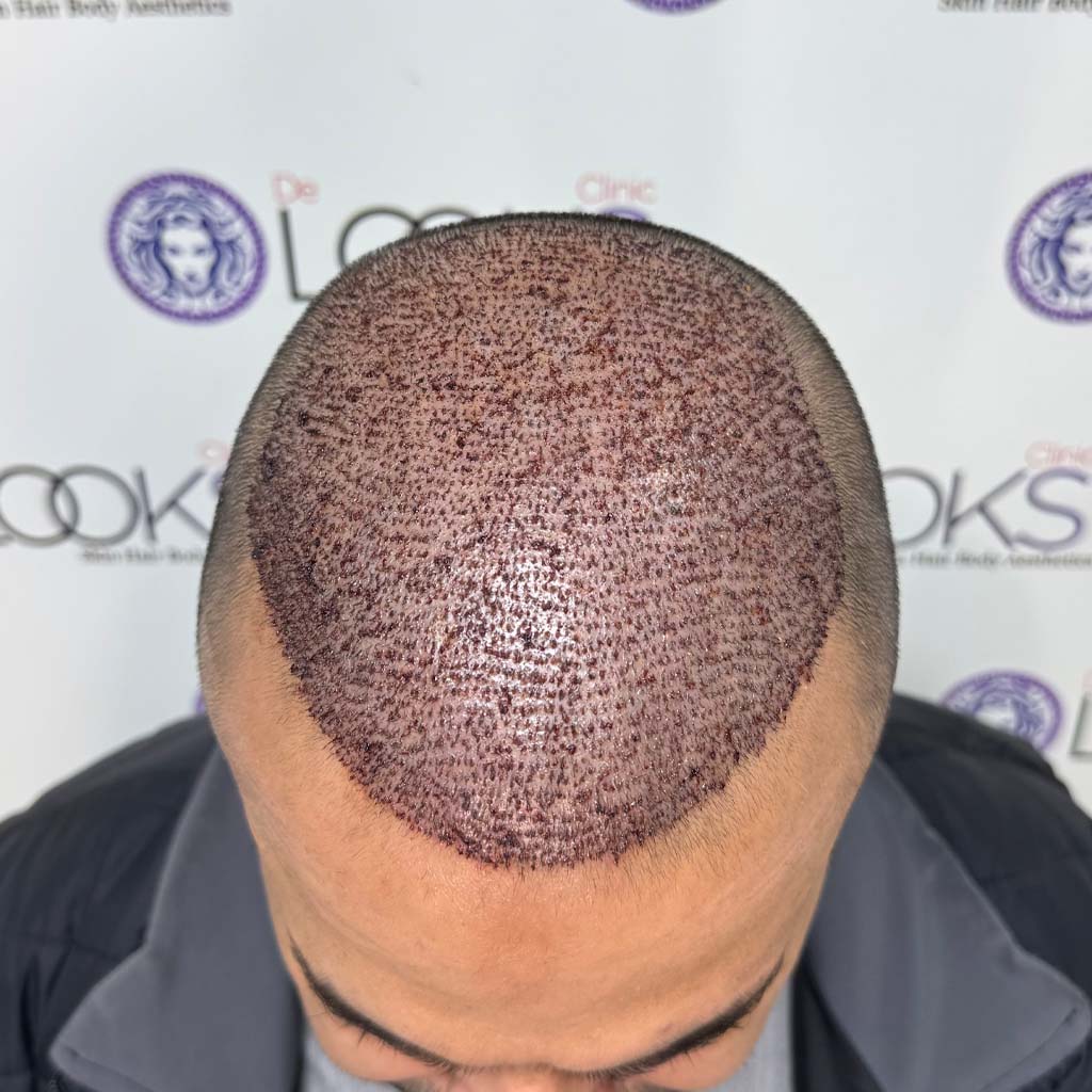 Hair Transplant Cost 2024 vs 2025 in Pakistan